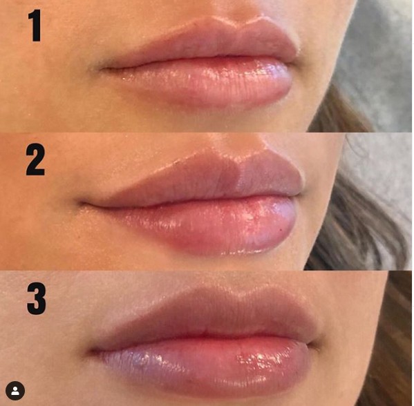 Inyección ácida hialurónica del llenador ultra 3 de Juvederm para los