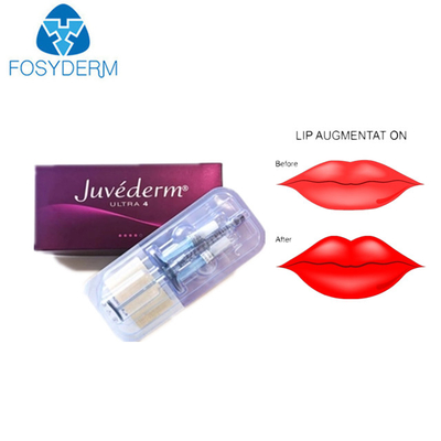 Llenador cutáneo ácido hialurónico ultra 3 de Juvederm para los labios de la cara