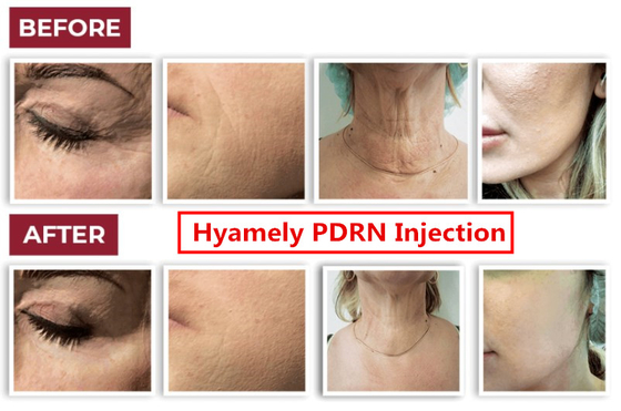 Suero del aumentador de presión PDRN de la piel de Regation de la célula de Hyamely para el cuello que blanquea la inyección facial