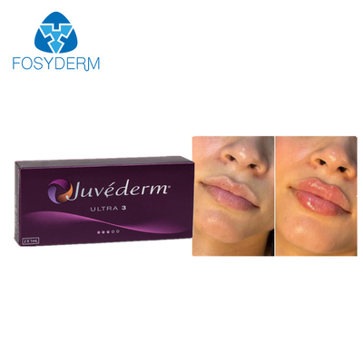 Juvederm 2*1ml Ácido hialurónico Relleno dérmico Aumento de labios Aumento de barbilla