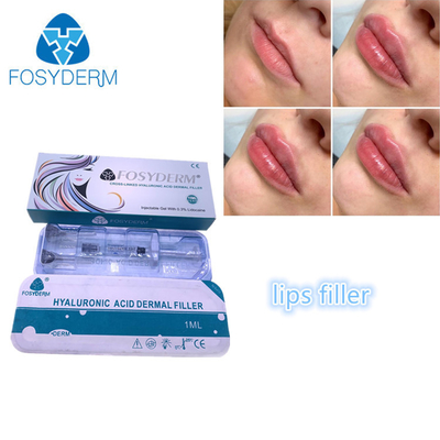 Llenadores ácidos hialurónicos de relleno 1ml del labio de Fosyderm Fosyderm de la inyección de la cara