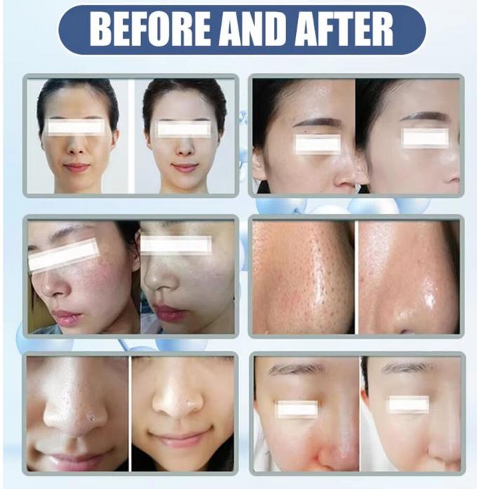 Mejor cuidado facial en el hogar Máquina de microdermoabrasión 2024 Equipo de belleza 6