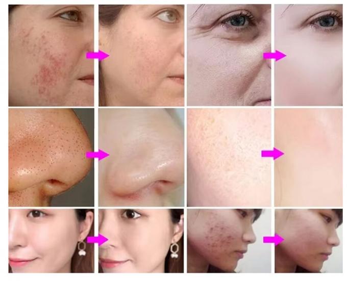 Hydra Peeling Facial Hydro Agua de burbujas pequeñas Hydro Aqua Facial H2o2 Máquina Hydra 2