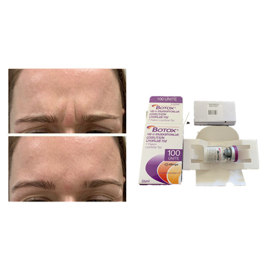 Inyección antienvejecedora de  de la toxina Botulinum blanca de Allergan