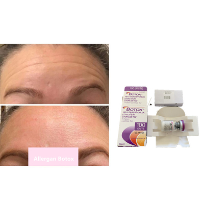Tipo Botulinum A de la toxina de Allergan s 100iu para las arrugas antis