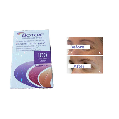 Arrugas Botulinum de la frente de las unidades de la toxina 100 de la inyección de Allergan Botox