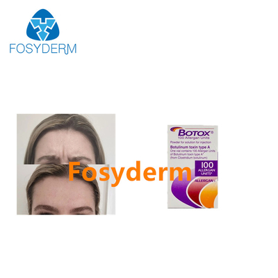 Inyección Botulinum de la toxina de Allergan  de 100 unidades para las arrugas antis