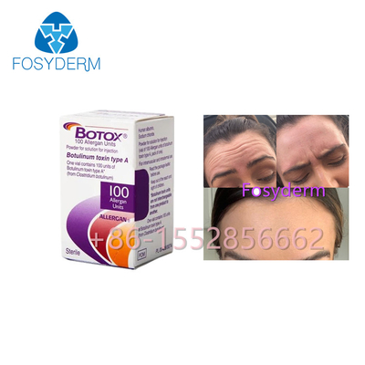 Allergan Botox 100 arrugas antis de la toxina Botulinum de las unidades mecanografía una inyección