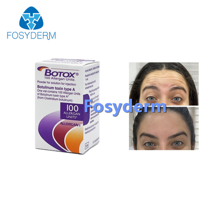 100Units Allergan Toxion Botulinum para quitan el tipo facial A de  de las arrugas