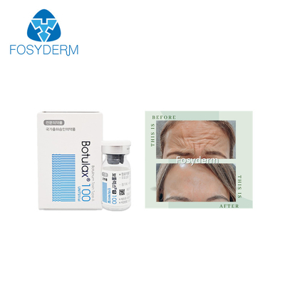 100 unidades mecanografían a toxina Botulinum Allergan la inyección facial anti de Botox Botulax de las arrugas