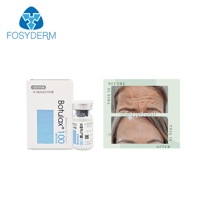 100 unidades mecanografían a toxina Botulinum Allergan la inyección facial anti de  Botulax de las arrugas