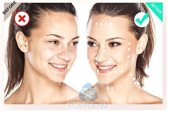 Filorga  135ha 5*3ml Inyección facial Mesoterapia para mejorar la calidad de la piel