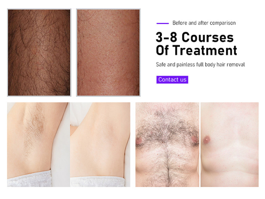 Equipo de belleza Máquina de depilación láser Fosyderm 3 ondas 12 barras