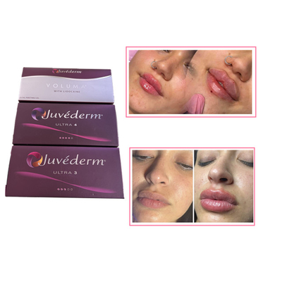 Inyecciones para el cuidado de la piel Plumper labial Juvederm Ácido hialurónico Relleno dérmico para la cara