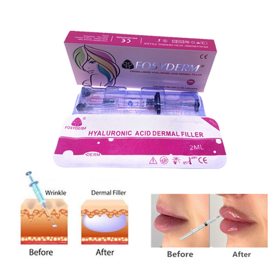 Fosyderm 2 ml Gel de ácido hialurónico inyecciones de relleno dérmico para el cuidado de la piel de la cara y la nariz