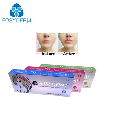 Gel de 1 ml de relleno de ácido hialurónico para la reducción de arrugas y la formación facial