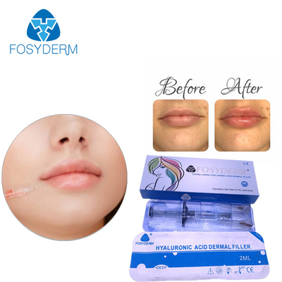 OEM Hyaluronic Acid Dermal Filler para piel llena y radiante