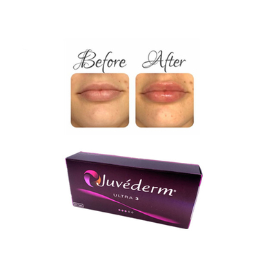 Juvederm Acido hialurónico inyectable Gel de relleno dérmico