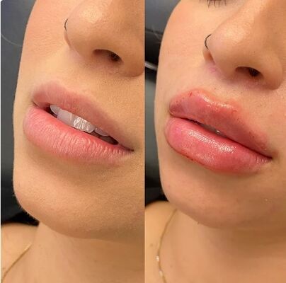 Red Lip Filler With Vitamin B12 Hyaluronic Acid Filler Gel For Lips