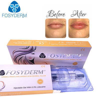 Ácido hialurónico Relleno dérmico Antirrugas Elevación facial 1 ml 2 ml