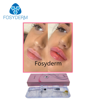Llenador cutáneo de la inyección del ácido hialurónico de la estética 1ml de Fosyderm para el aumento de los labios