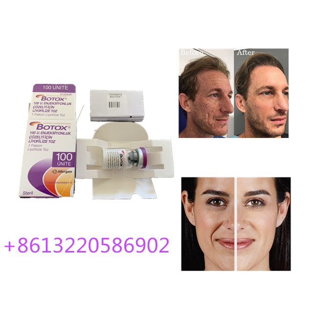 La inyección antienvejecedora 100units de Allergan  mecanografía una arruga anti