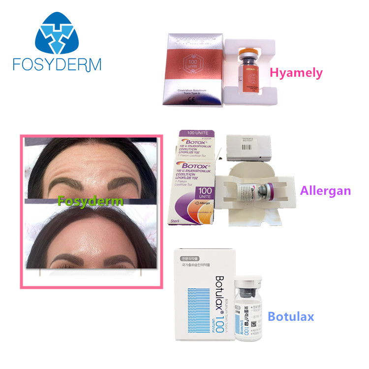100 unidades mecanografían a toxina Botulinum Allergan la inyección facial anti de  Botulax de las arrugas