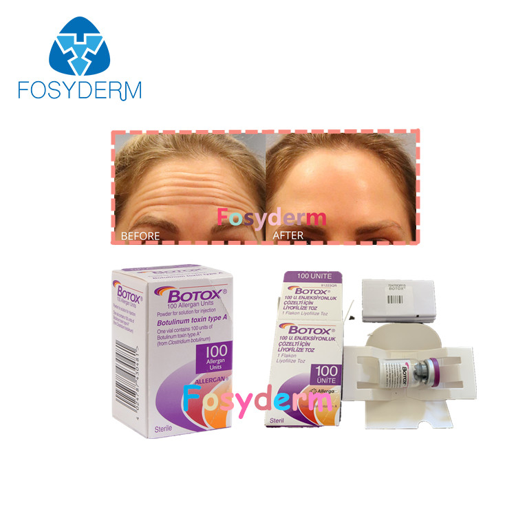 inyección anti Botulinum TypeA  de Allergan de la toxina de la arruga 100Units