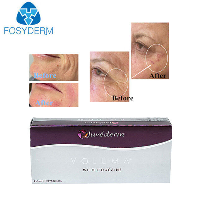 Juvederm Hyaluronic Acid Dermal Filler Face Face Lifting 24mg