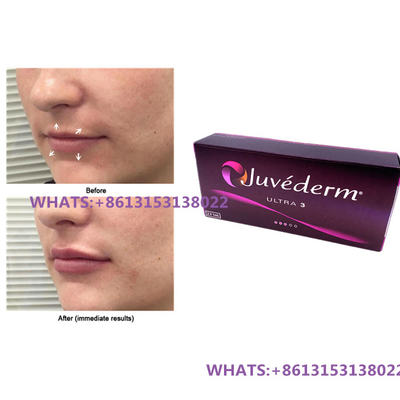 Juvederm Relleno dérmico para labios Juvederm Ultra3 Ultra4 Rellenes Siringa precargada