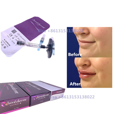 2×1 ml de inyección de relleno dérmico Juvederm Ultra3 Ultra4