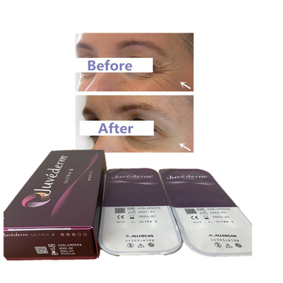 Llenador cutáneo ácido hialurónico 24mg del labio del llenador de Juvederm 2ml Ultra3 Ultra4 Voluma