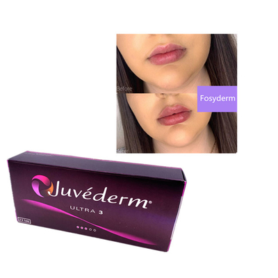 2 ml de Juvederm ácido hialurónico relleno cutáneo relleno de arrugas Barbilla labios Ultra 3