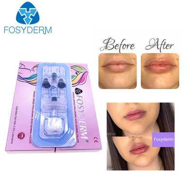Llenador cutáneo ácido hialurónico profundo de la certificación 1ml Derm ha del CE para los labios