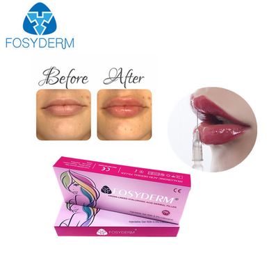inyección ácida hialurónica del aumento del labio de Derm de los llenadores del labio 1ml para las mujeres
