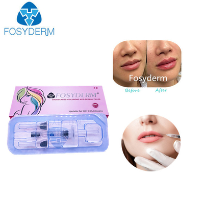 La cruz hialurónica ácida de 2 ml ligó inyecciones cutáneas del llenador del labio del llenador